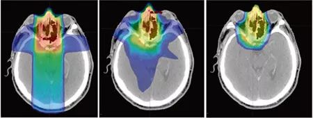 全球最新治疗癌症的进展,质子重离子治愈率最高的六种癌症