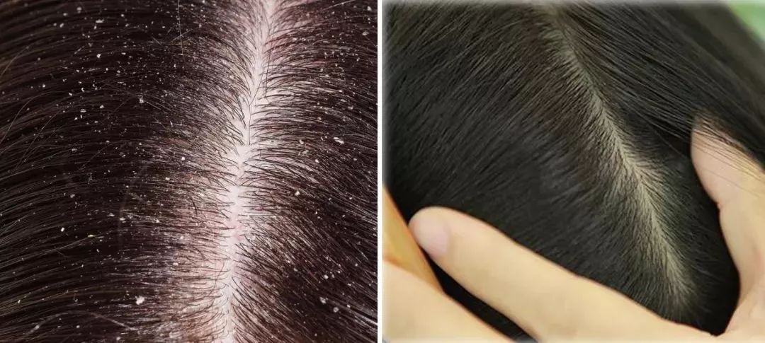 除螨仪只要一块钱有效去除螨虫,澳洲去螨虫喷雾