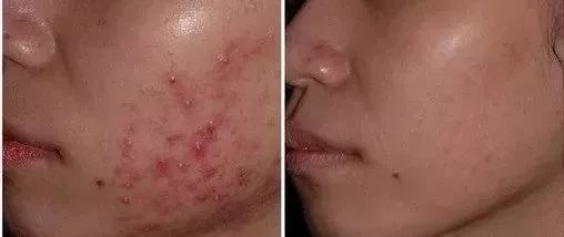 除螨仪只要一块钱有效去除螨虫,澳洲去螨虫喷雾