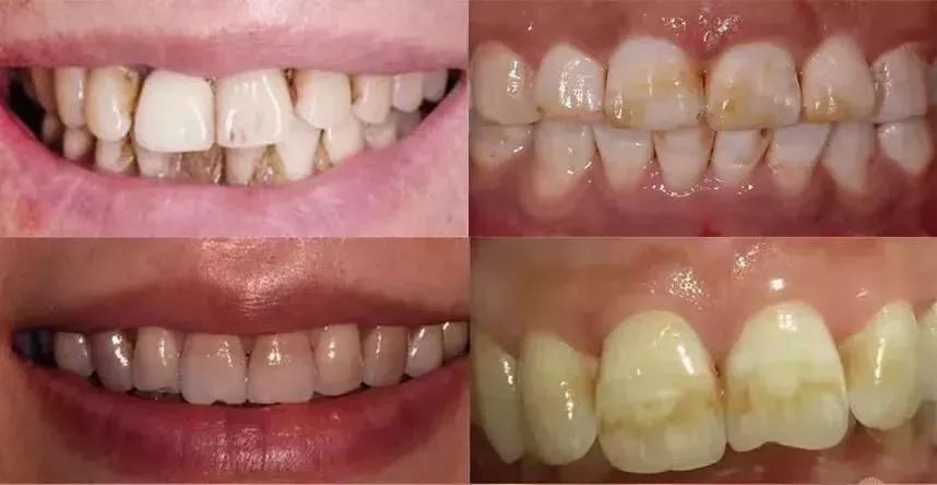 俄罗斯牙膏美白去口臭牙黄,去牙垢黄牙的牙膏测评