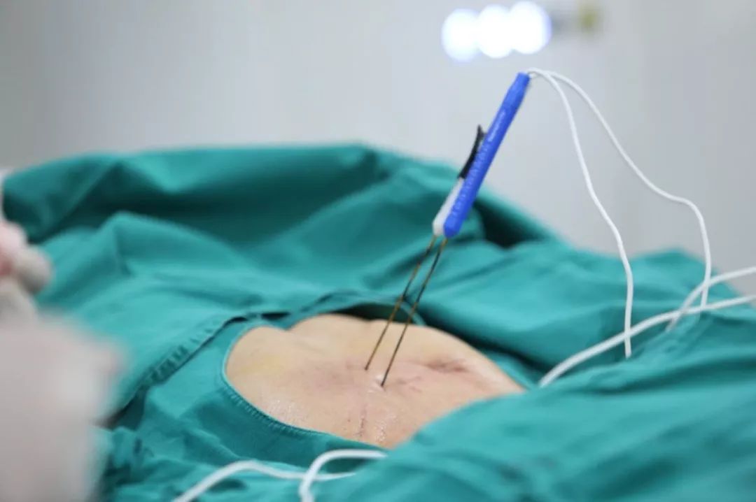 肝癌合并门静脉癌栓怎么办,纳米刀成对付癌中王的新利器