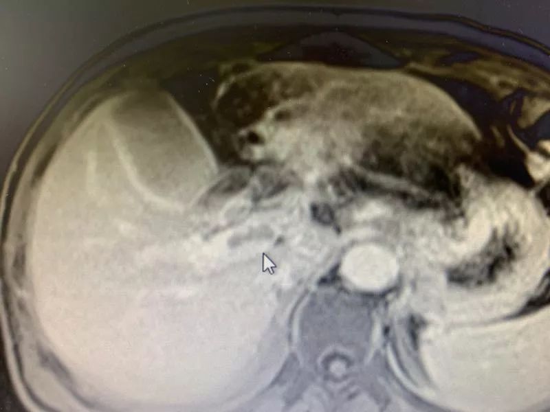 肝癌合并门静脉癌栓怎么办,纳米刀成对付癌中王的新利器