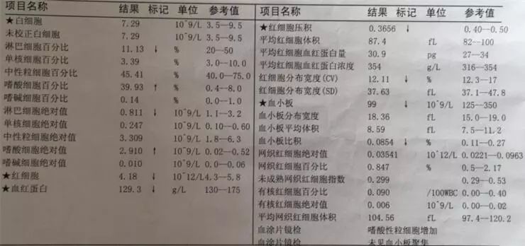 亚急性心内膜炎有蛋白尿吗,loeffler心内膜炎发病概率