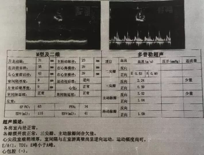 亚急性心内膜炎有蛋白尿吗,loeffler心内膜炎发病概率