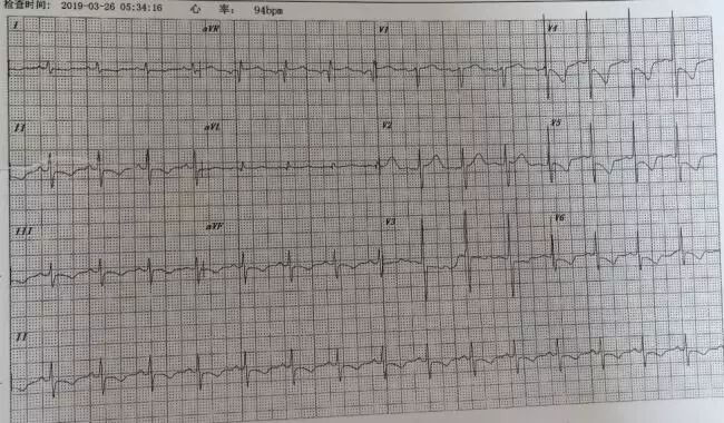 亚急性心内膜炎有蛋白尿吗,loeffler心内膜炎发病概率