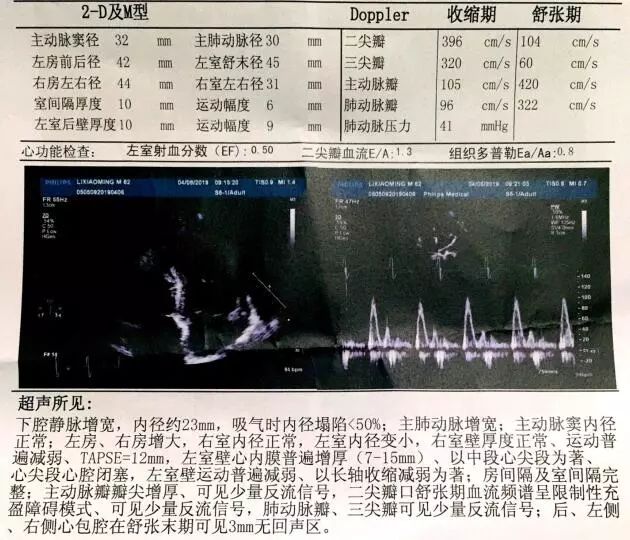 亚急性心内膜炎有蛋白尿吗,loeffler心内膜炎发病概率