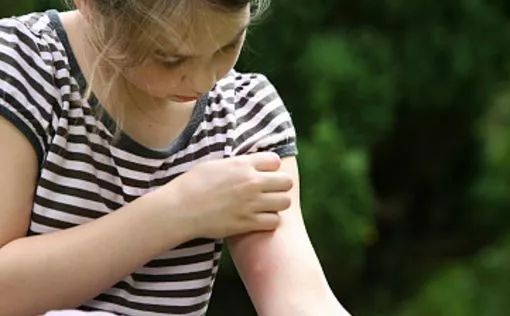 总被蚊子咬？涂点这个马上止痒，还不花一分钱