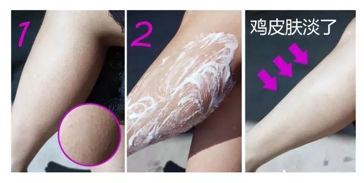 鸡皮肤怎么穿露背装,短期内快速去除鸡皮肤