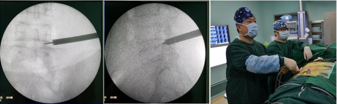 腰椎间盘突出椎间孔镜手术指南,椎间孔镜微创治疗腰椎间盘突出症