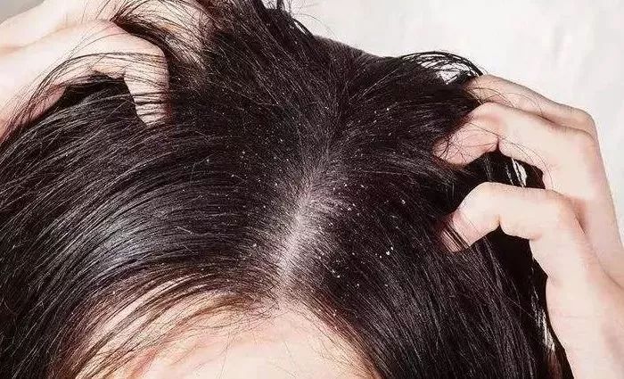 头皮除螨虫神器哪种好用,头屑头油清除神器第一名