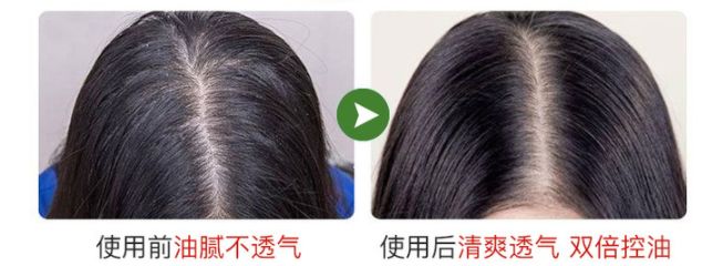 头皮除螨虫神器哪种好用,头屑头油清除神器第一名
