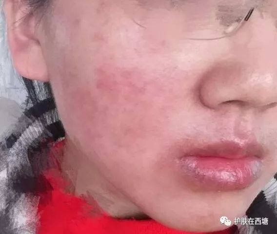 激素依赖性皮炎怎么才能彻底治好,激素依赖性皮炎好了以后怎么护肤