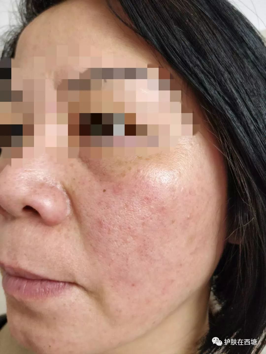 激素依赖性皮炎怎么才能彻底治好,激素依赖性皮炎好了以后怎么护肤