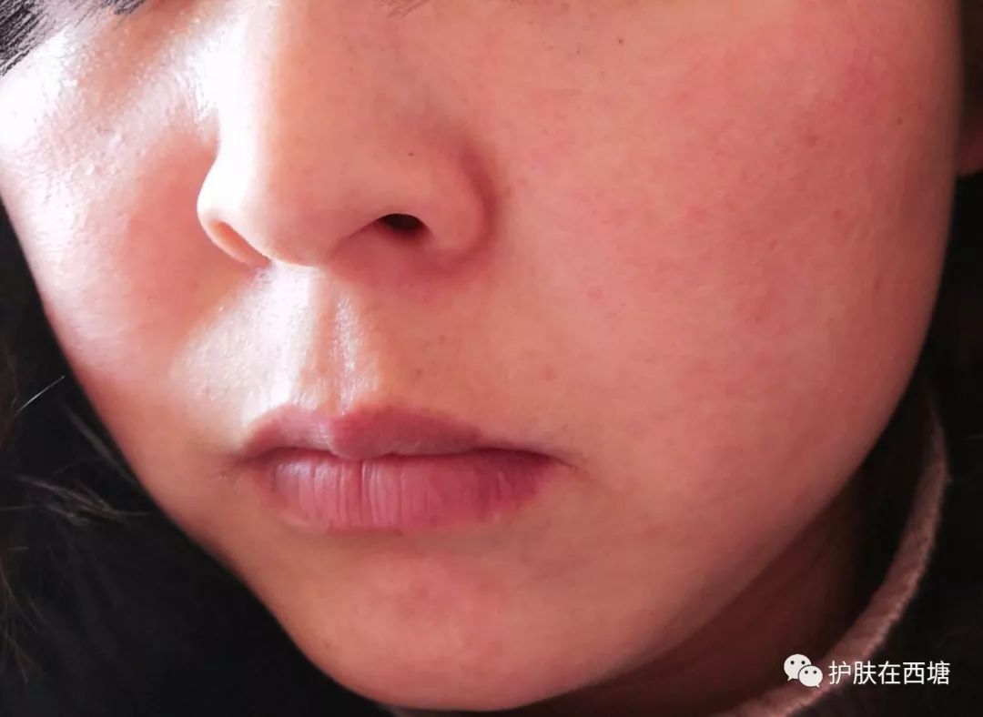 激素依赖性皮炎怎么才能彻底治好,激素依赖性皮炎好了以后怎么护肤