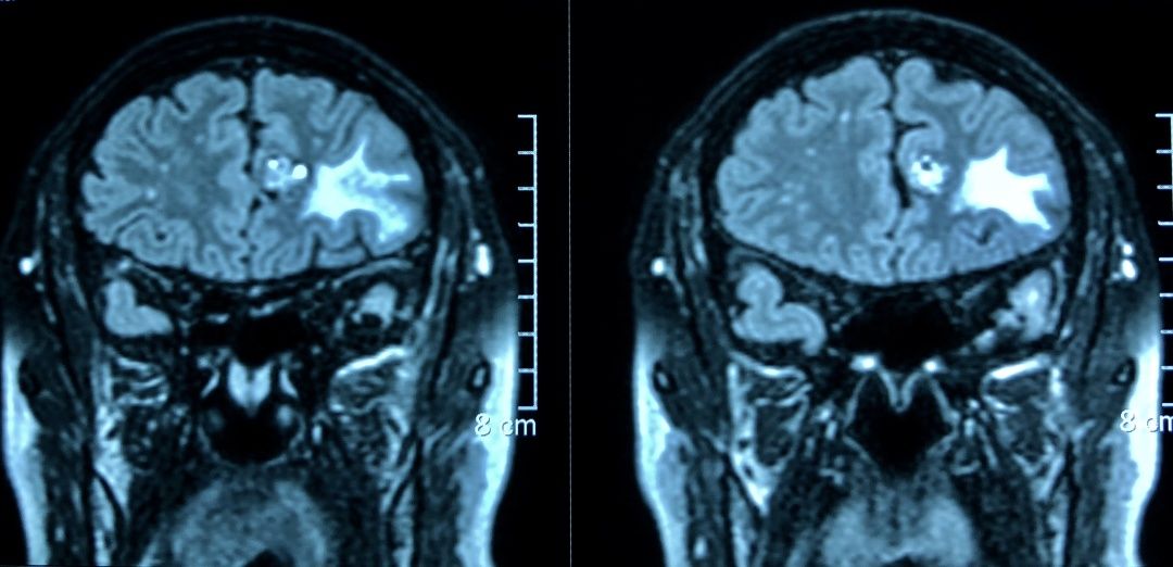头晕头疼脑里长了脑瘤,脑袋晕晕沉沉有可能是脑瘤吗