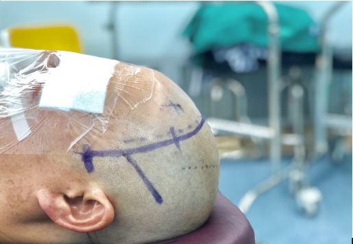 头晕头疼脑里长了脑瘤,脑袋晕晕沉沉有可能是脑瘤吗