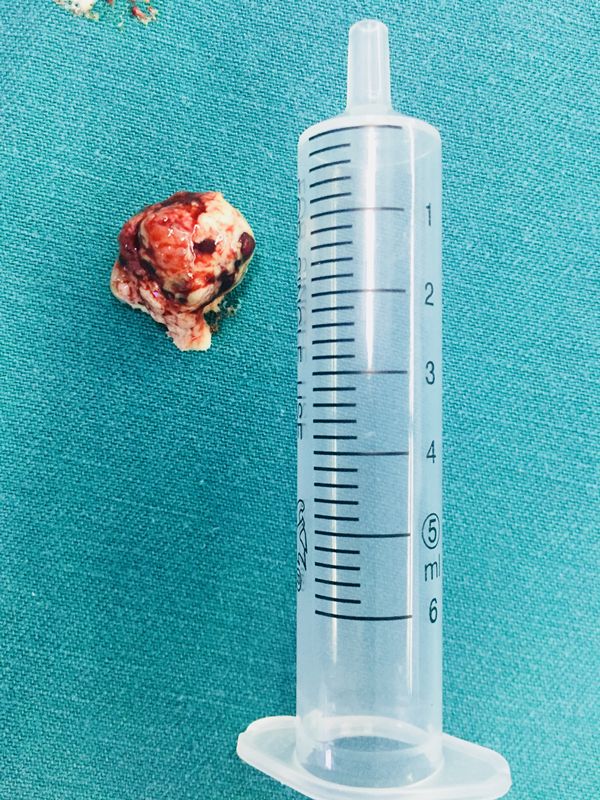 头晕头疼脑里长了脑瘤,脑袋晕晕沉沉有可能是脑瘤吗