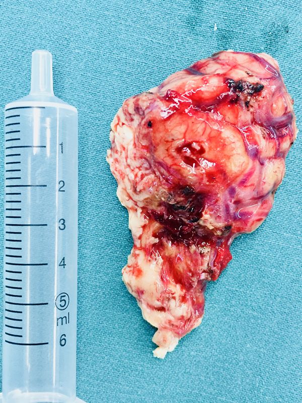 头晕头疼脑里长了脑瘤,脑袋晕晕沉沉有可能是脑瘤吗