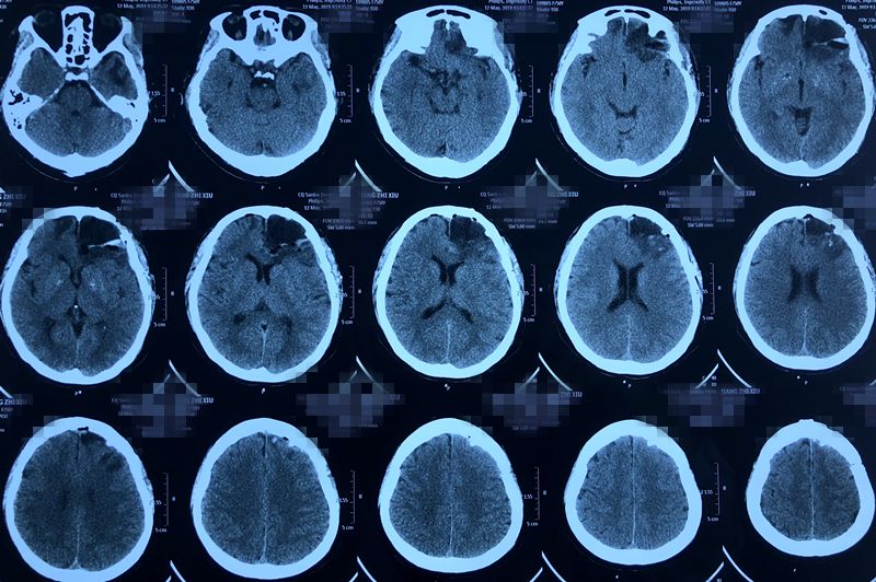 头晕头疼脑里长了脑瘤,脑袋晕晕沉沉有可能是脑瘤吗