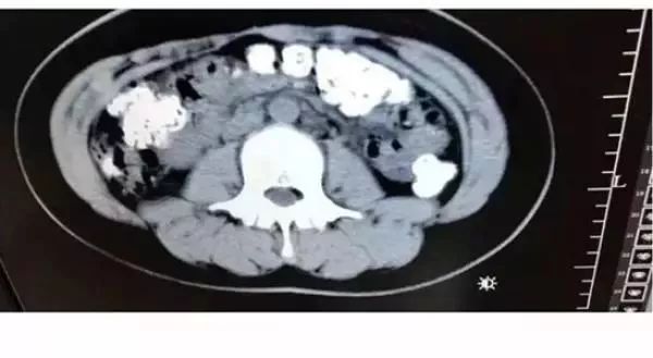 14岁女孩便秘5天了,女孩便秘14天