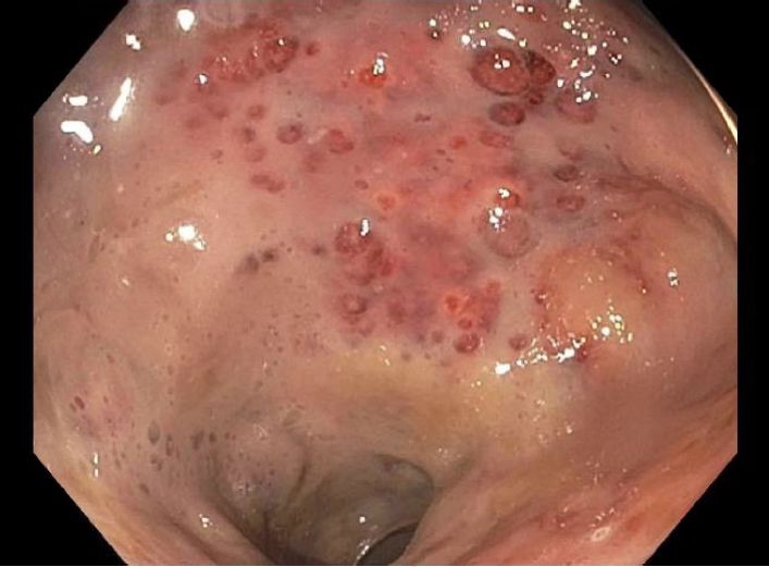 病例分享|一键保存!年轻女性因直肠疼痛而无法坐下?