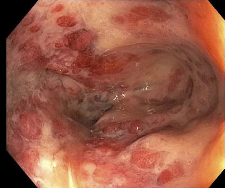 病例分享|一键保存!年轻女性因直肠疼痛而无法坐下?