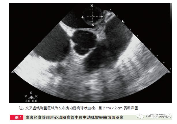患者女55岁有心绞痛病史1年,房颤的球形血栓