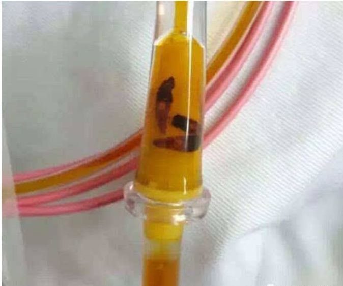 吃完这种菜,男子突然眼珠发黄,尿色如豆油!很多食物能吃出这个病,夏天千万注意...