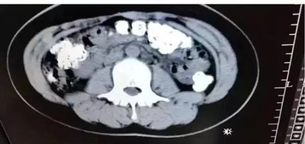 14岁女孩肚子疼，CT检查发现胃、肠、一直到…密密麻麻全是阴影