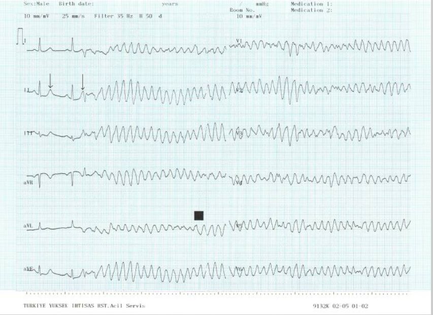 急性心梗后能恢复正常吗,急性心梗缓解后还需要支架吗