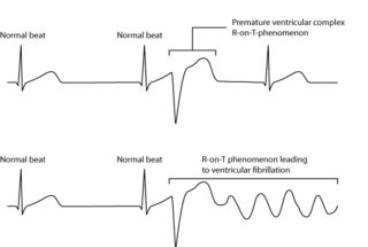 急性心梗后能恢复正常吗,急性心梗缓解后还需要支架吗