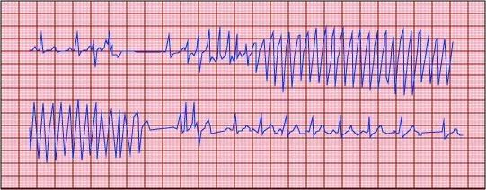 急性心梗后能恢复正常吗,急性心梗缓解后还需要支架吗
