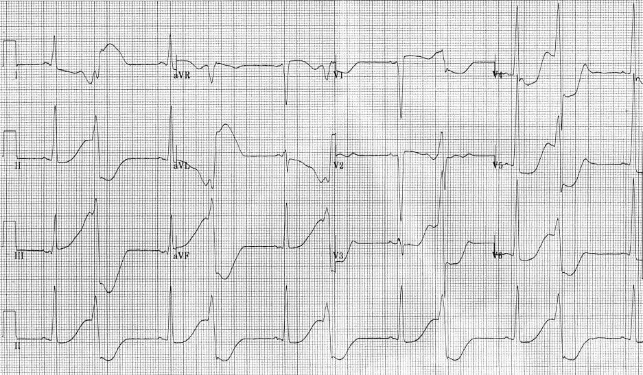 急性心梗后能恢复正常吗,急性心梗缓解后还需要支架吗