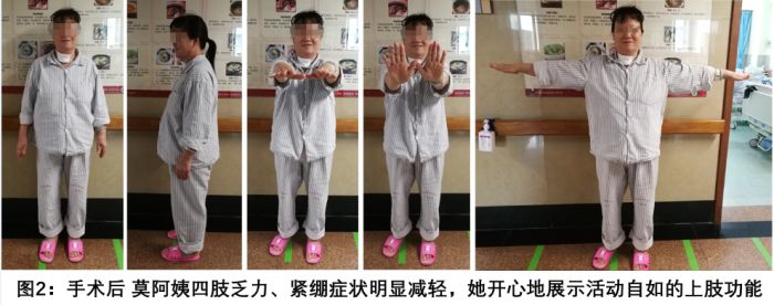 脊柱外科优秀的护理讲课视频,脊柱外科优质护理服务总结