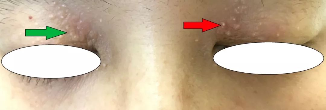 眼周有细纹用什么眼霜好用,眼周细纹用手针还是滚针