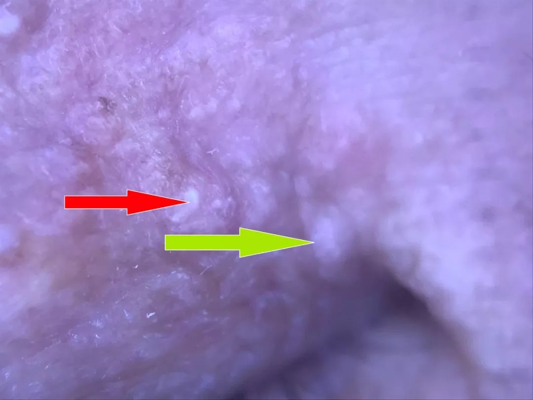 眼周有细纹用什么眼霜好用,眼周细纹用手针还是滚针