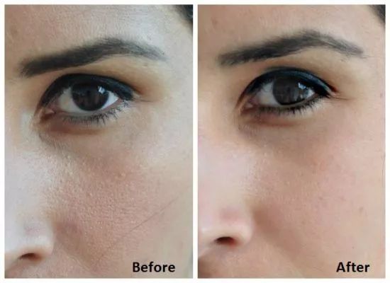 毛孔粗大的克星精华,毛孔粗大什么药材可以改善