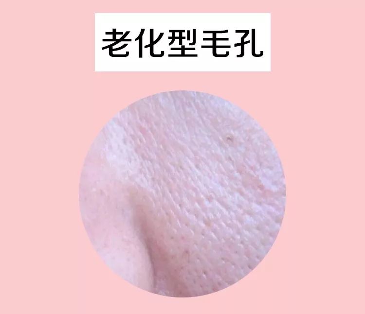 毛孔粗大的克星精华,毛孔粗大什么药材可以改善