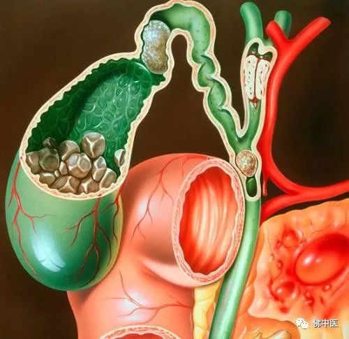 治疗胆石的最好方法,攻克胆石最好的方法