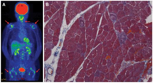 多发性肌炎和皮肌炎哪个更重,多发性肌炎与抗合成酶综合征区别