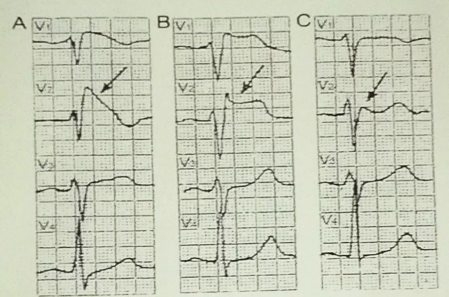吴永全：如何运用体表心电图预测心脏性猝死风险？｜OCC2019