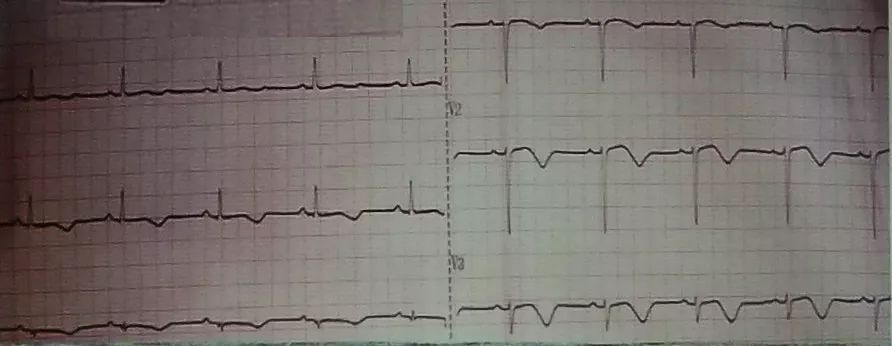 吴永全：如何运用体表心电图预测心脏性猝死风险？｜OCC2019