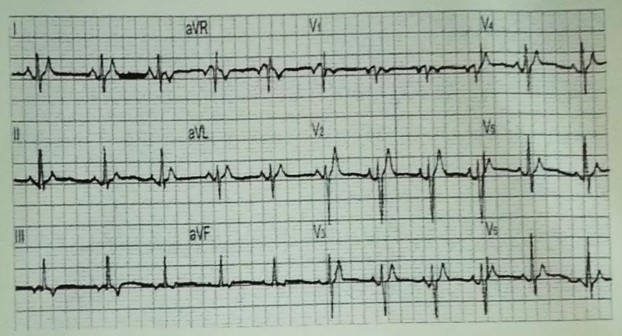 吴永全：如何运用体表心电图预测心脏性猝死风险？｜OCC2019