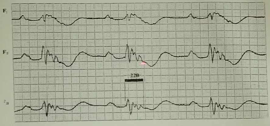 吴永全：如何运用体表心电图预测心脏性猝死风险？｜OCC2019