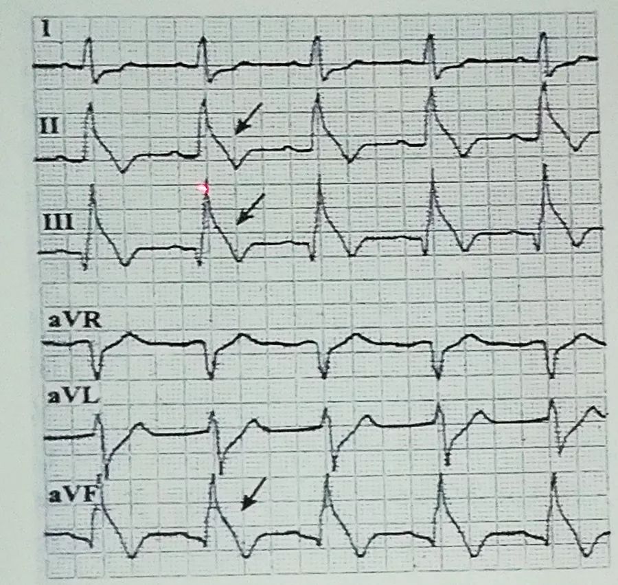 吴永全：如何运用体表心电图预测心脏性猝死风险？｜OCC2019