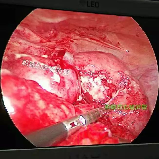 挑战│克服重重困难,腹腔镜为患者解除病痛