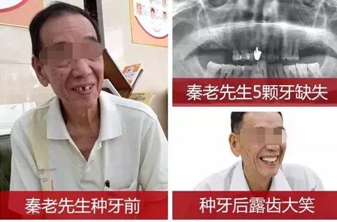 缺牙修复补贴政策,缺牙补牙补贴