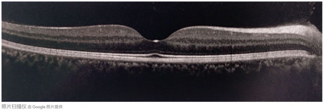 眼底黄斑病变一般多久会失明,眼底黄斑病的养护和注意事项