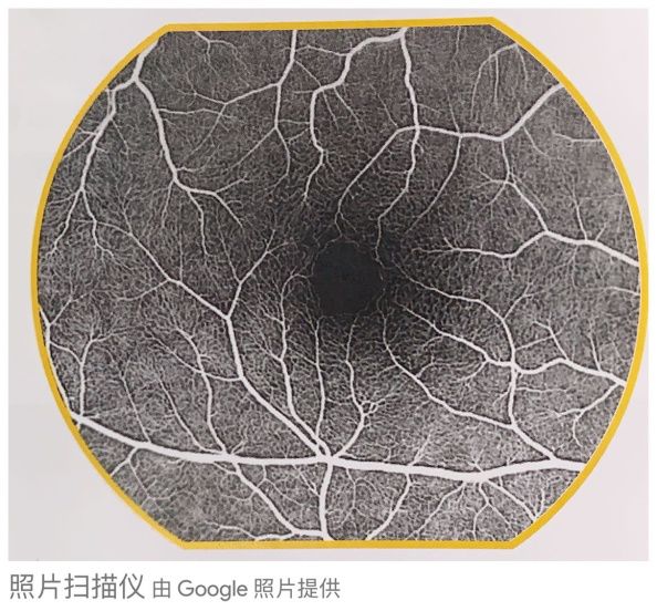 眼底黄斑病变一般多久会失明,眼底黄斑病的养护和注意事项