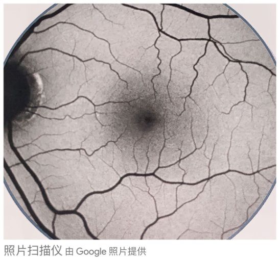 眼底黄斑病变一般多久会失明,眼底黄斑病的养护和注意事项